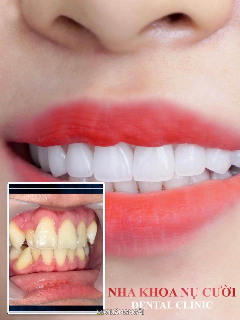 Nha Khoa Nụ Cười sẽ giúp bạn sở hữu hàm răng trắng xinh như ý